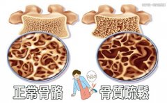 警惕骨密度 了解其诱因