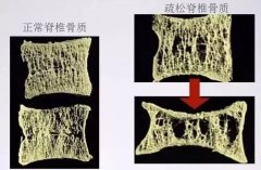 哪些人群需重点关注骨密度检查，需及时补钙