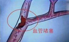 雷竞技时时乐攻略：打个喷嚏竟能诱发脑梗?