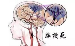 脑血管健康风险脑梗的相关知识详解