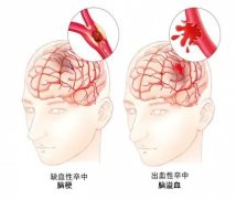 脑卒中健康风险的检查讲解