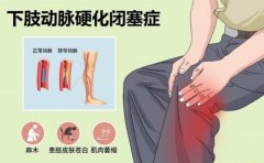 什么样的人群需要用动脉硬化检测仪检查身体